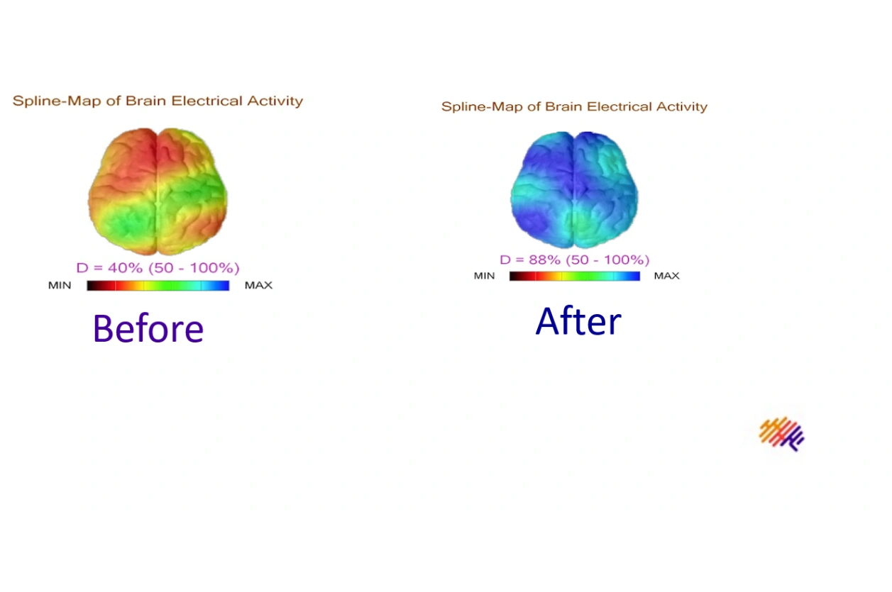 Spline-Map of Brain Electrical Activity before and after BrainTap